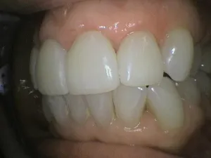 Before and After