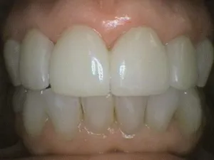 Before and After