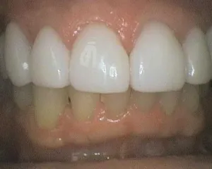Before and After