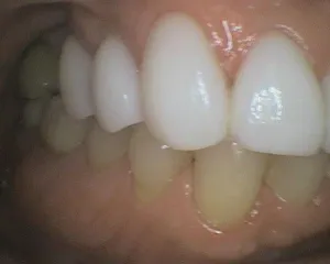 Before and After