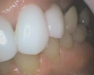 Before and After