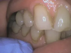 Before and After