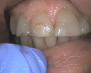 Before and After