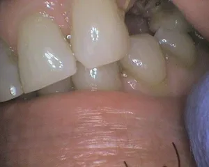 Before and After