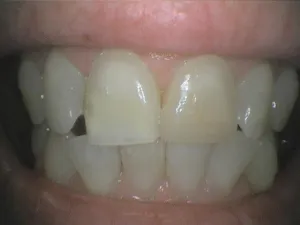 Before and After