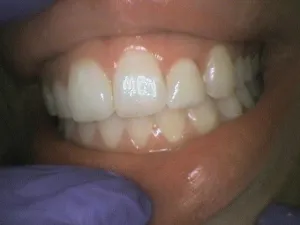 Before and After