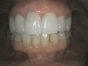 Before and After