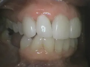 Before and After