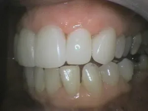 Before and After