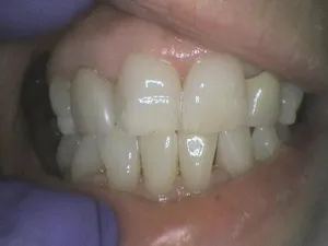 Before and After