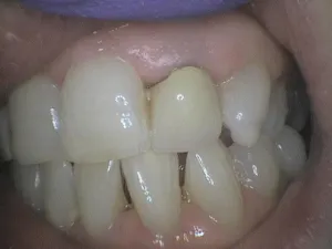 Before and After