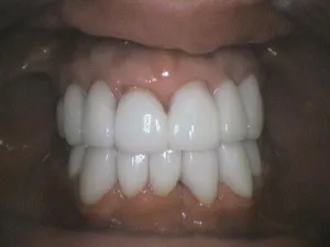 Before and After