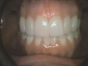 Before and After