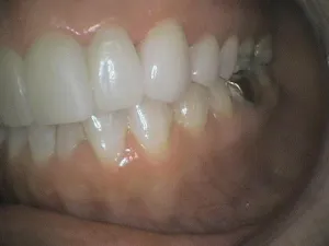 Before and After