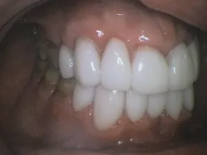 Before and After