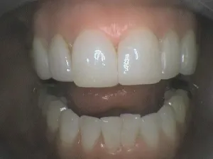 Before and After