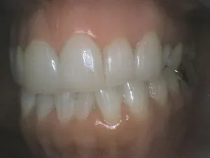 Before and After