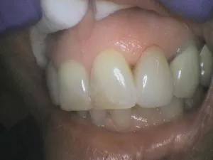 Before and After