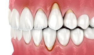gum disease example